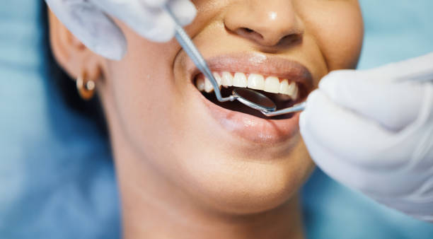 Best Knocked-Out Tooth (Avulsed Tooth) Treatment in Grill, PA